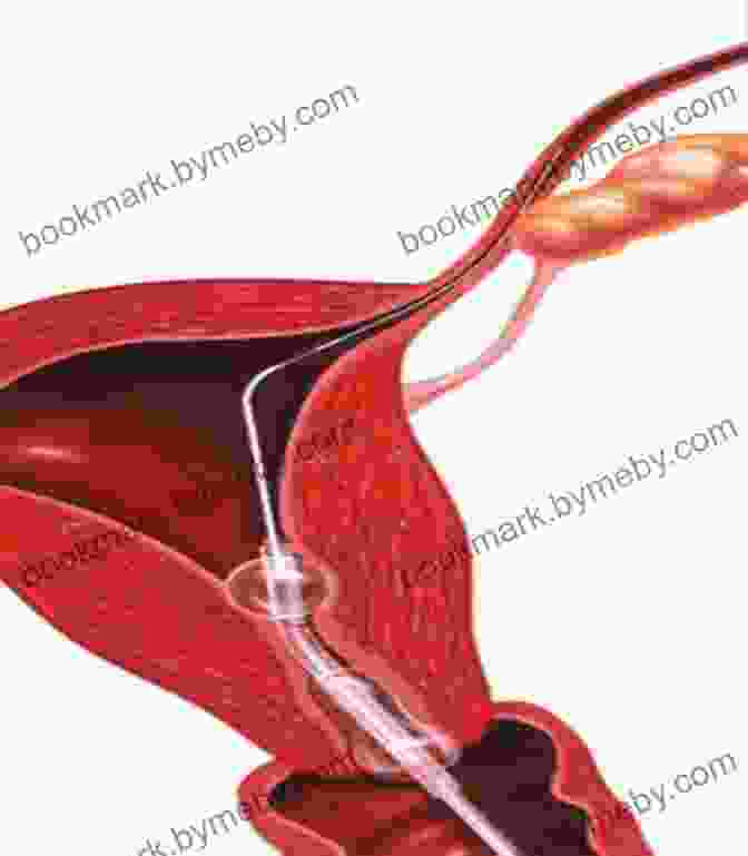 Endometriosis Can Obstruct The Fallopian Tubes Or Interfere With Implantation. Female Infertility What You Should Know