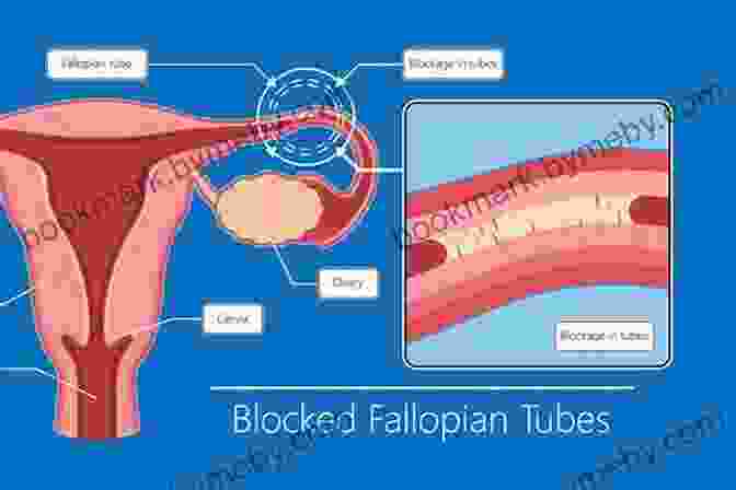 Fallopian Tube Blockages Can Prevent The Egg From Reaching The Uterus. Female Infertility What You Should Know