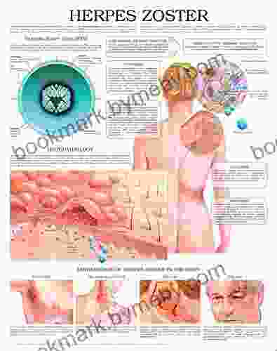 Herpes Zoster E Chart: Full Illustrated